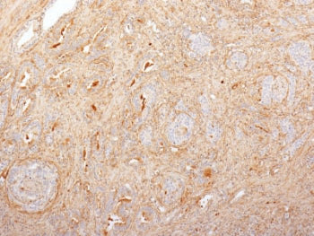 IHC staining of FFPE human prostate carcinoma with Fibronectin antibody (clone 616). HIER: boil tiss