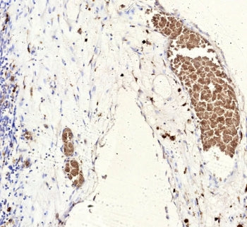 IHC staining of FFPE human Ewing Sarcoma tissue with recombinant Fli1 antibody (clone rFLI1/9614). H