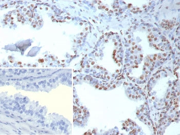 IHC staining of FFPE human prostate tissue with recombinant TDP43 antibody (clone TARDP/9299R). Inse