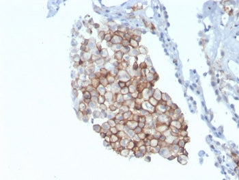 IHC staining of FFPE human lung carcinoma with CD86 antibody (clone C86/3711). HIER: boil tissue sec