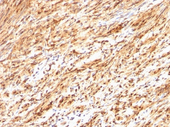 IHC staining of FFPE human schwanoma with S100B antibody. HIER: boil tissue sections in pH 9 10mM Tr
