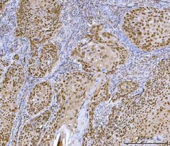 IHC staining of FFPE human laryngeal squamous cell carcinoma tissue with Homeobox protein cut-like 1