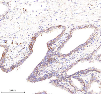 Immunohistochemical staining of POC1A using anti-POC1A antibody. POC1A was detected in a paraffin-em