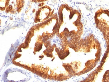 IHC: Formalin-fixed, paraffin-embedded human prostate carcinoma stained with CK18 antibody (clone KR