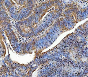 IHC staining of FFPE human colorectal adenocarcinoma tissue with TTLL12 antibody. HIER: boil tissue
