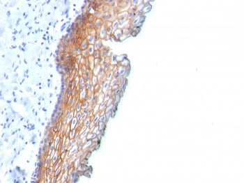 IHC staining of FFPE human esophageal carcinoma with Desmoglein 3 antibody (clone DSG3/2838). HIER: