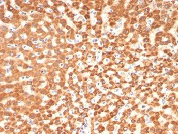 IHC staining of FFPE human hepatocellular carcinoma tissue with SHBG antibody (clone SHBG/8175). HIE
