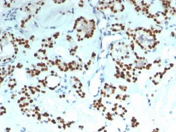 IHC staining of FFPE human thyroid with recombinant PAX8 antibody (clone rPAX8/1492). HIER: boil tis