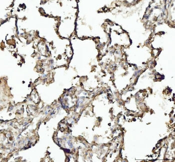 IHC testing of FFPE human lung cancer tissue with Annexin VI antibody. Required HIER: steam section