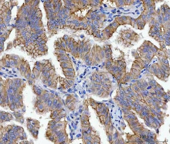 IHC staining of FFPE human lung adenocarcinoma tissue with JUP antibody. HIER: boil tissue sections