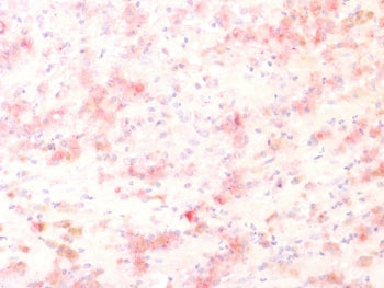 IHC testing of FFPE human melanoma with recombinant TYRP1 antibody, HRP secondary and AEC chromogen.