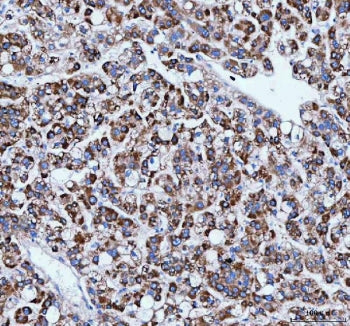 IHC staining of FFPE human liver cancer tissue with IARS1 antibody. HIER: boil tissue sections in pH