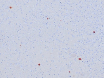 IHC staining of FFPE human HSV-infected tissue with Herpes Simplex Virus Type I antibody (clone HSVI