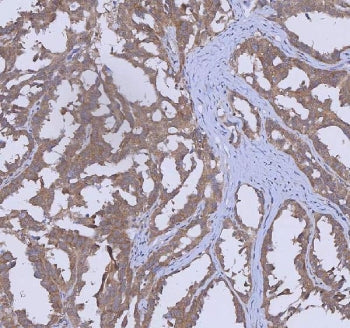 IHC staining of FFPE human ovarian cancer tissue with WDR44 antibody. HIER: boil tissue sections in