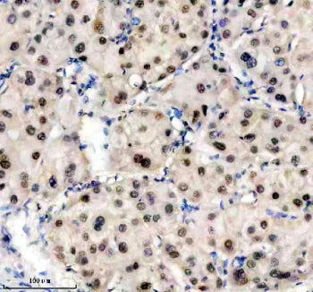 Immunohistochemical staining of TRIM47 using anti-TRIM47 antibody. TRIM47 was detected in a paraffin