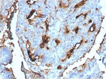 IHC staining of FFPE human breast carcinoma with CDC34 antibody (clone CPTC-CDC34-2). HIER: boil tis