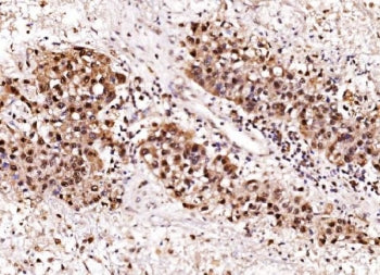 IHC staining of FFPE human liver cancer tissue with Aurora A antibody. HIER: boil tissue sections in