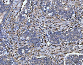 IHC staining of FFPE human duodenal adenocarcinoma with HLA-DRA antibody. HIER: boil tissue sections