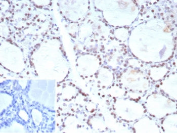 IHC staining of FFPE human prostate carcinoma tissue with FOXP1 antibody (clone FOXP1/9381R). Inset: