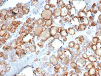 IHC staining of FFPE human thyroid carcinoma tissue with Thyroid Peroxidase antibody (clone TPO/7088