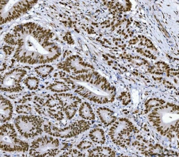 IHC staining of FFPE human colorectal adenocarcinoma tissue with RCC1 antibody. HIER: boil tissue se