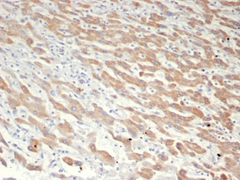 IHC staining of FFPE human liver in HCC with GFRP antibody (clone GCHFR/7731). HIER: boil tissue sec
