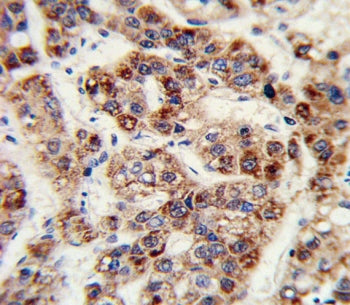 IHC staining of FFPE human hepatocarcinoma tissue with Ornithine transcarbamylase antibody. HIER: st