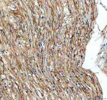 Immunohistochemical staining of TGFBI using anti-TGFBI antibody. TGFBI was detected in a paraffin-em