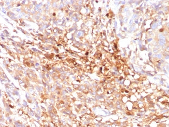 IHC staining of FFPE human triple negative breast cancer tissue with Cyclin B1 antibody (clone CCNB1
