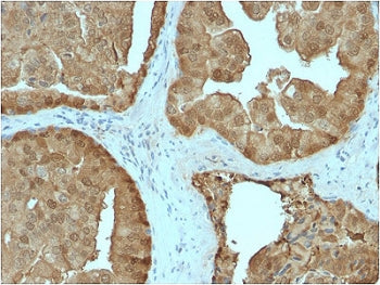 IHC testing of FFPE human prostate carcinoma stained with GLO1 antibody. Required HIER: boiling tiss