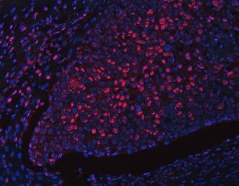 Immunofluorescent staining of FFPE human esophageal squamous cell carcinoma tissue with RFX1 antibod