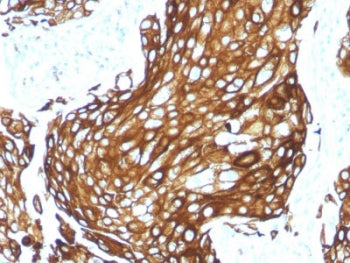 IHC staining of FFPE human lung carcinoma with recombinant Acidic Cytokeratin. HIER: boil tissue sec
