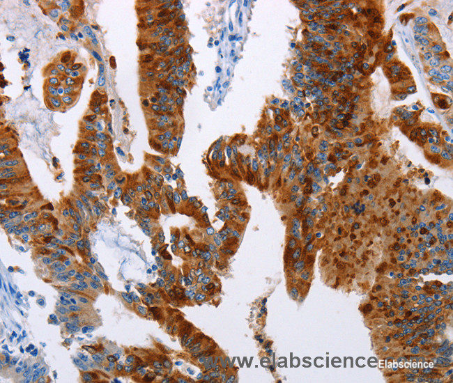 Immunohistochemistry of paraffin-embedded Human colon cancer tissue using TFF3 Polyclonal Antibody at dilution 1:50