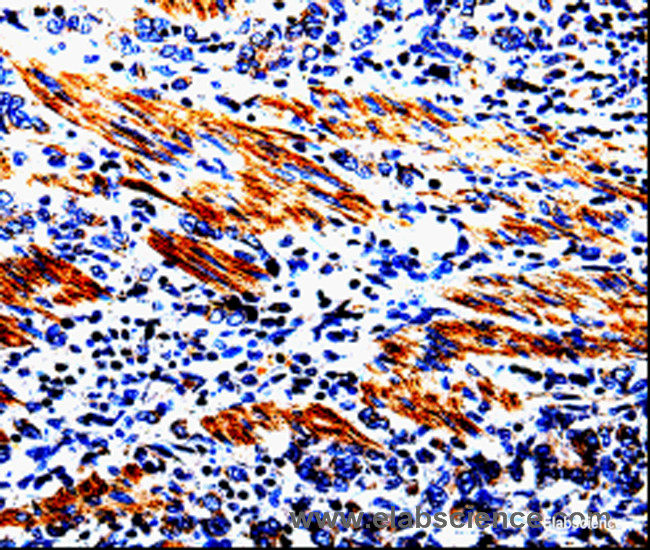 Immunohistochemistry of paraffin-embedded Human stomach cancer tissue using ACSBG2 Polyclonal Antibody at dilution 1:60