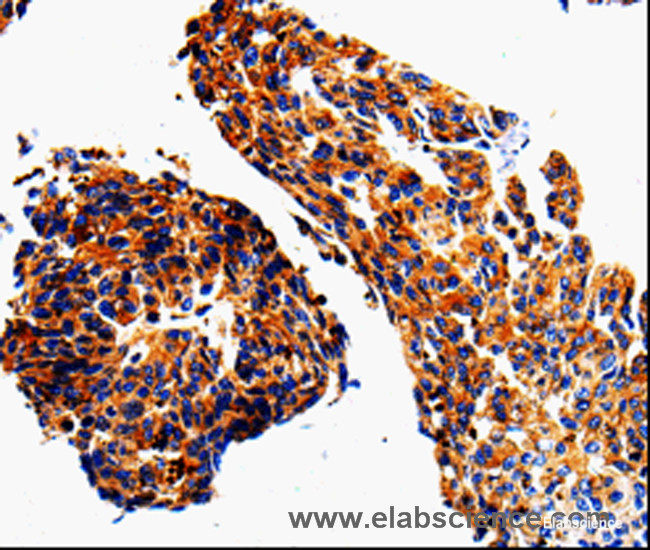 Immunohistochemistry of paraffin-embedded Human lung cancer tissue using ADD1 Polyclonal Antibody at dilution 1:50