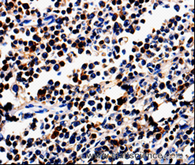 Immunohistochemistry of paraffin-embedded Human colon cancer tissue using ALOX5 Polyclonal Antibody at dilution 1:50