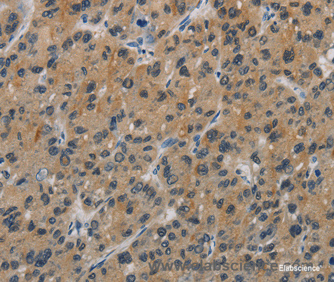 Immunohistochemistry of paraffin-embedded Human liver cancer tissue using CASP9 Polyclonal Antibody at dilution 1:60