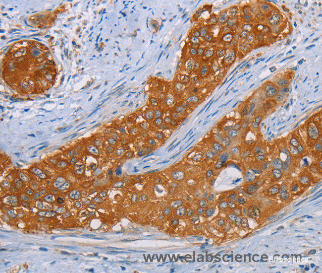 Immunohistochemistry of paraffin-embedded Human cervical cancer tissue using MMP1 Polyclonal Antibody at dilution 1:55