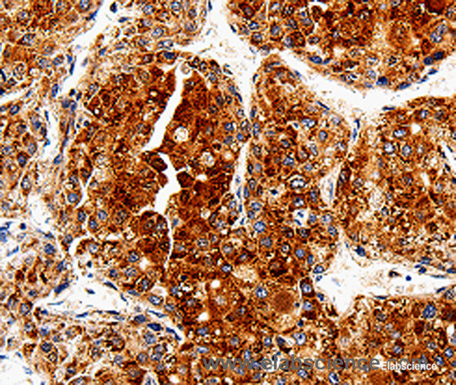 Immunohistochemistry of paraffin-embedded Human liver cancer tissue using COX19 Polyclonal Antibody at dilution 1:50