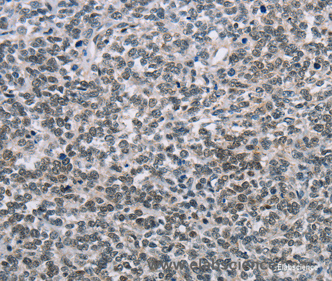 Immunohistochemistry of paraffin-embedded Human ovarian cancer tissue using TONSL Polyclonal Antibody at dilution 1:60