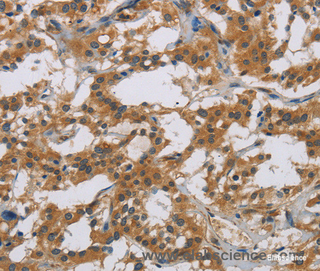 Immunohistochemistry of paraffin-embedded Human thyroid cancer tissue using IL18R1 Polyclonal Antibody at dilution 1:40