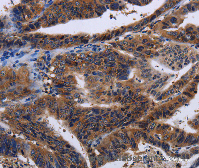 Immunohistochemistry of paraffin-embedded Human gasrtic cancer tissue using HTR2B Polyclonal Antibody at dilution 1:60