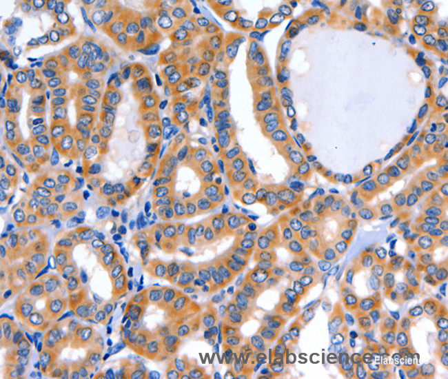 Immunohistochemistry of paraffin-embedded Human thyroid cancer tissue using GFER Polyclonal Antibody at dilution 1:50