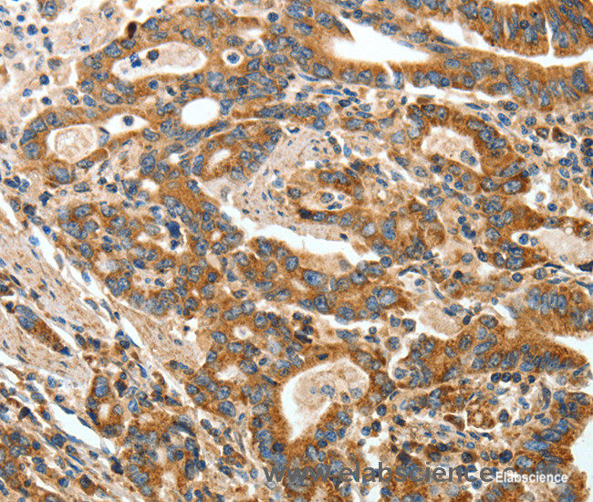 Immunohistochemistry of paraffin-embedded Human gasrtic cancer tissue using ANGPTL1 Polyclonal Antibody at dilution 1:40