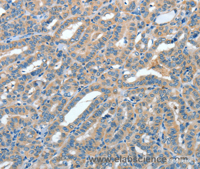 Immunohistochemistry of paraffin-embedded Human thyroid cancer tissue using ANGPT1 Polyclonal Antibody at dilution 1:50