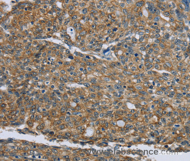 Immunohistochemistry of paraffin-embedded Human ovarian cancer tissue using CK-5 Polyclonal Antibody at dilution 1:30