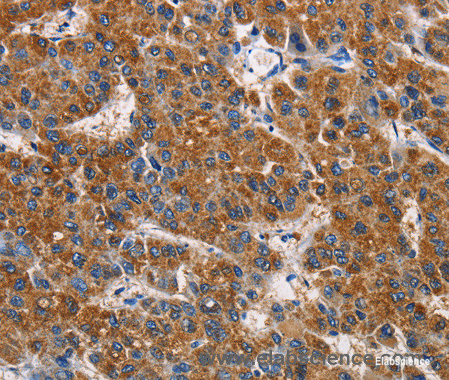 Immunohistochemistry of paraffin-embedded Human liver cancer tissue using APLNR Polyclonal Antibody at dilution 1:50