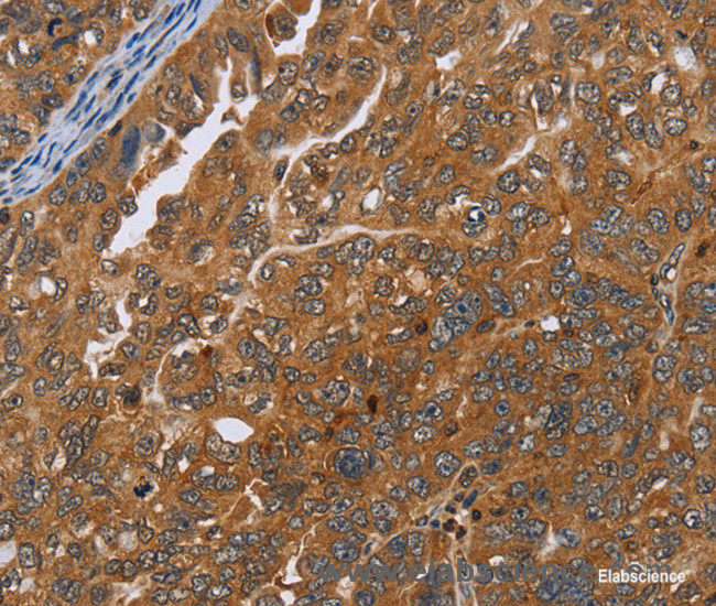 Immunohistochemistry of paraffin-embedded Human ovarian cancer tissue using ADAMTS15 Polyclonal Antibody at dilution 1:40