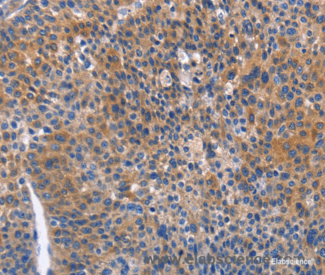Immunohistochemistry of paraffin-embedded Human liver cancer tissue using ARRB1 Polyclonal Antibody at dilution 1:50