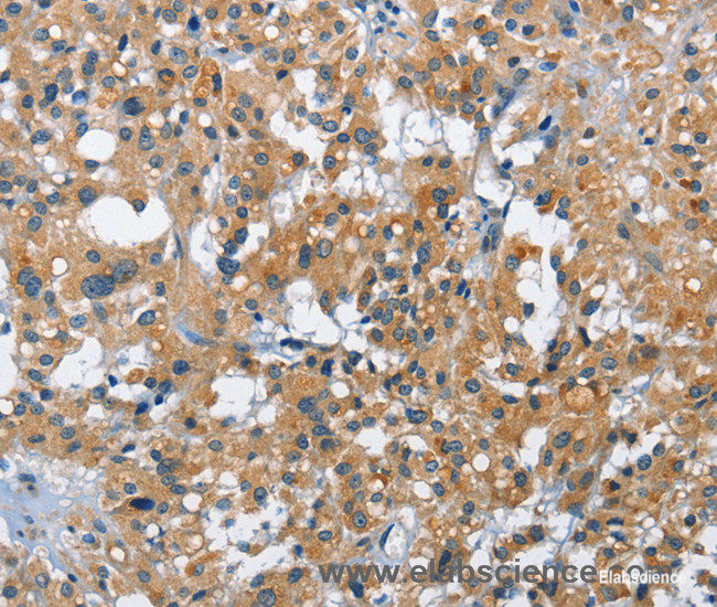 Immunohistochemistry of paraffin-embedded Human thyroid cancer tissue using CREB2 Polyclonal Antibody at dilution 1:40